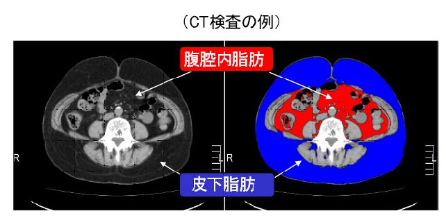 CT検査の例